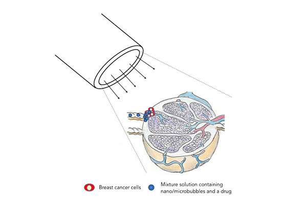 درمان سرطان متاستاتیک پستان با صوت