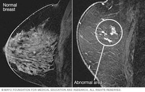 تصاویر توده پستان و پستان معمولی در MRI 
