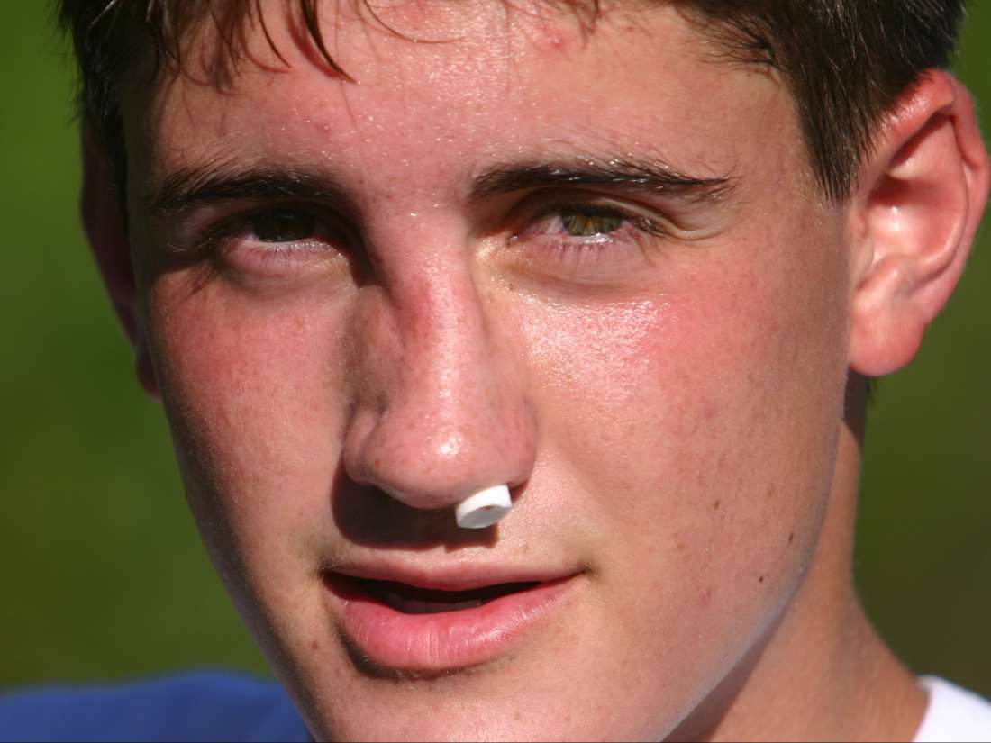 بعد از ضربه به بینی چه کنیم و علائم شکستگی بینی چیست؟ دکتر مجازی