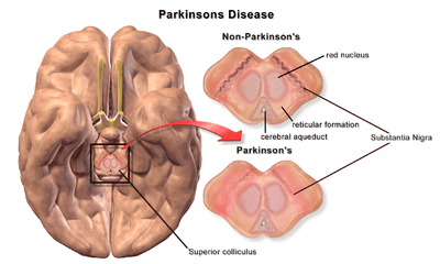 پاتوفیزیولوژی بیماری پارکینسون