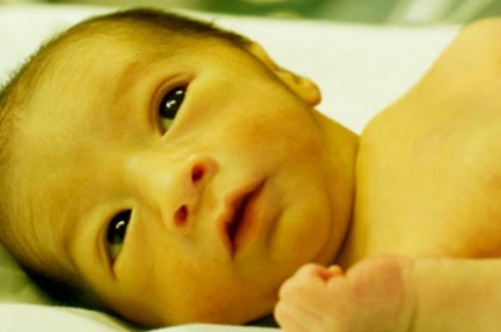 کرنیکتروس نوزادی چیست : علت، تشخیص و درمان