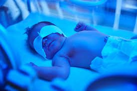 فتوتراپی یا نور درمانی در زردی نوزادان