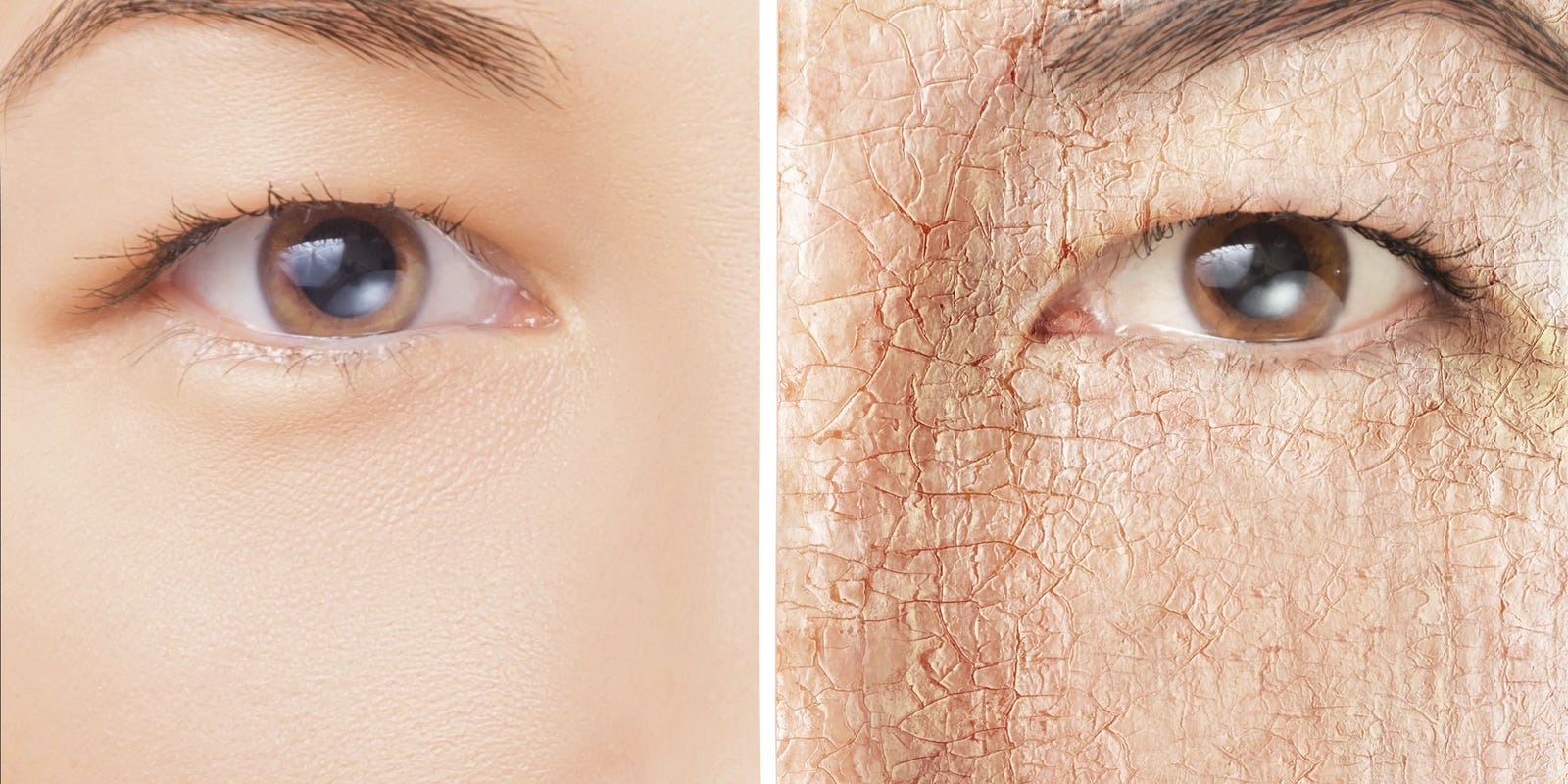 خشکی پوست در زمستان و راه‌های درمان آن