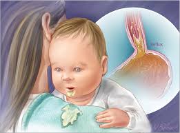 رفلاکس نوزاد چیست