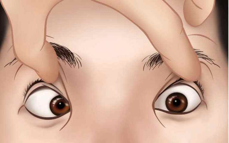 انحراف چشم