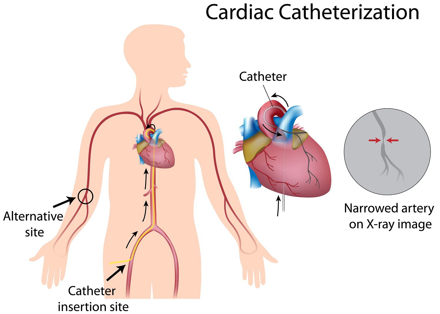 کاتتریزاسیون قلبی چیست و چگونه انجام می شود؟