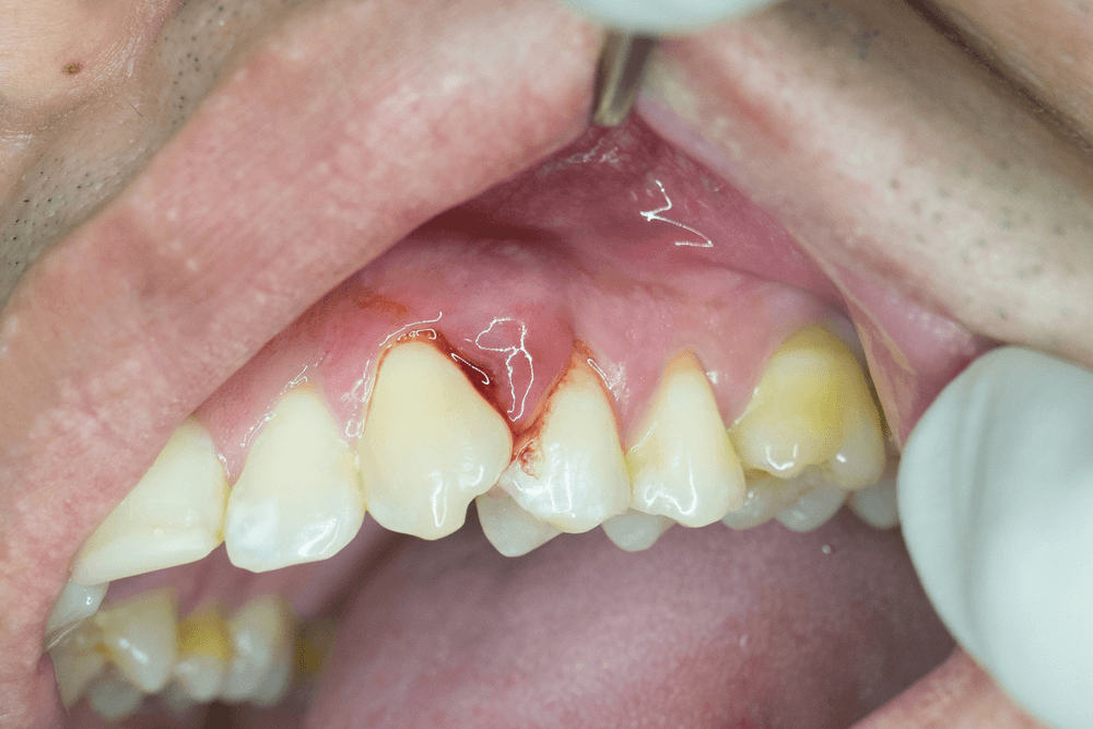 عفونت در ریشه دندان