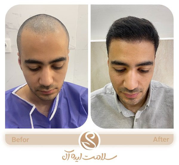 نمونه کار کاشت مو بهترین کلینیک زیبایی در مشهد