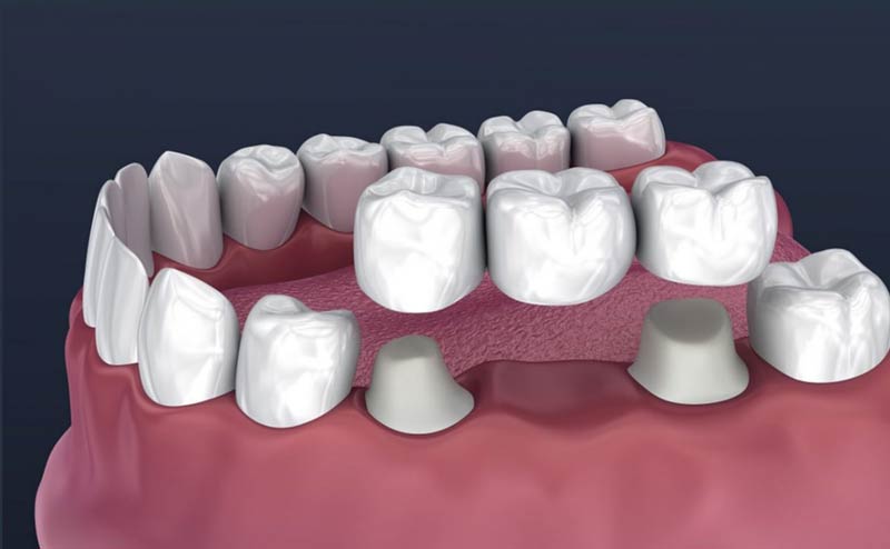 dental-bridge