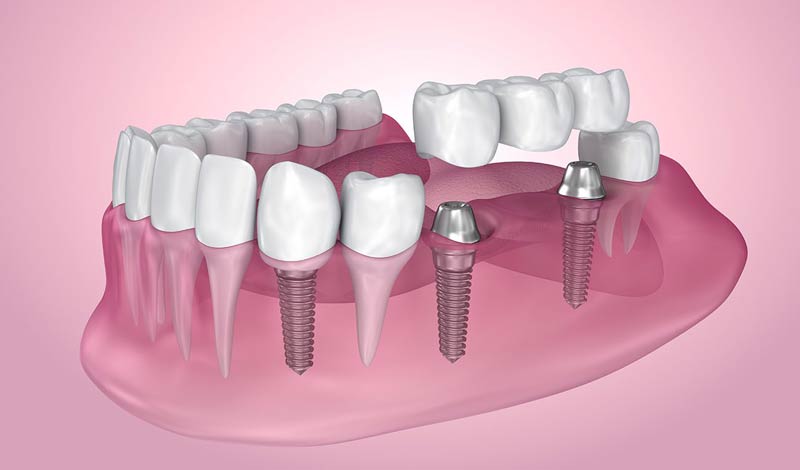 dental-implants