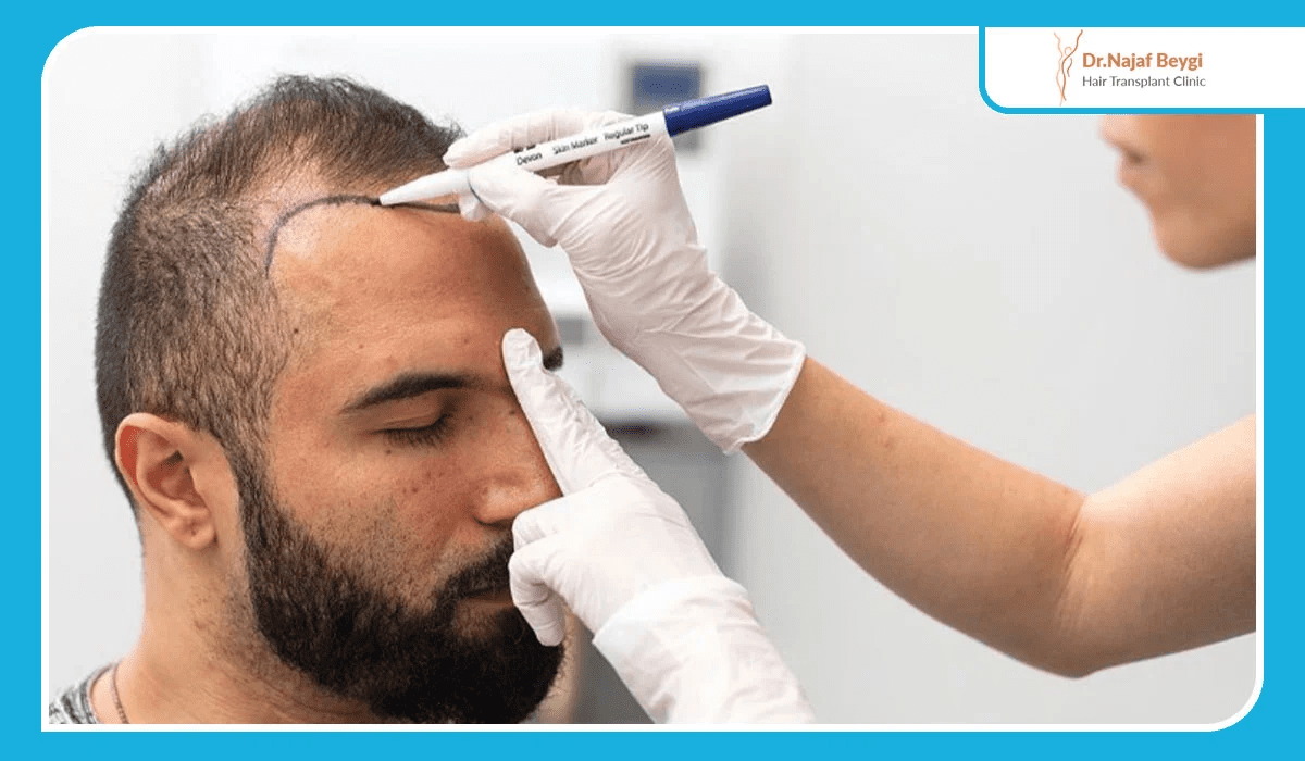 تفاوت‌های روش Biofiber با کاشت مو سنتی