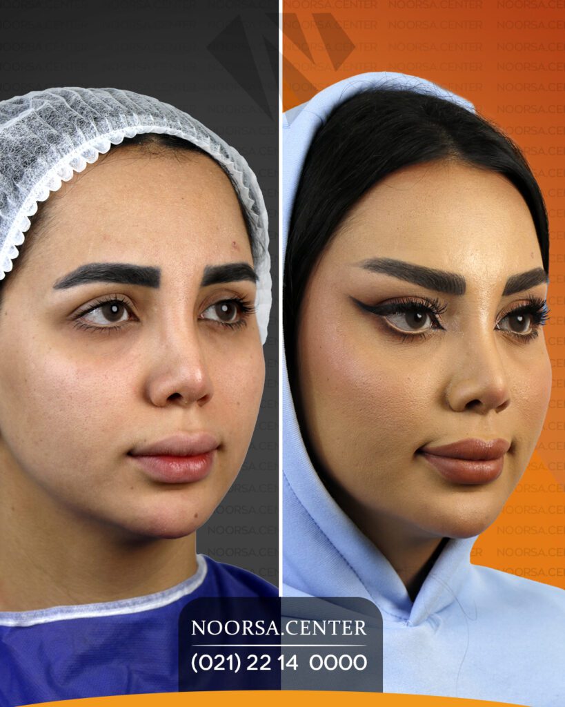 قبل و بعد از لیفت شقیقه