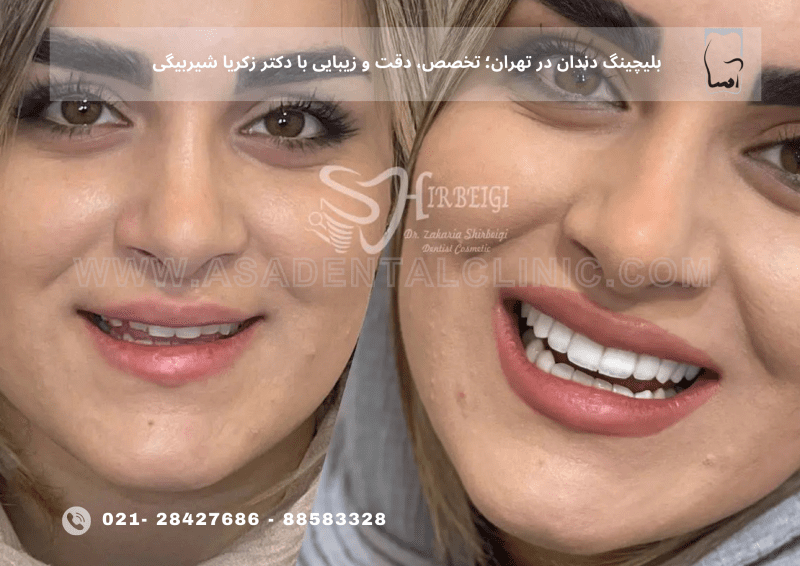 بلیچینگ دندان