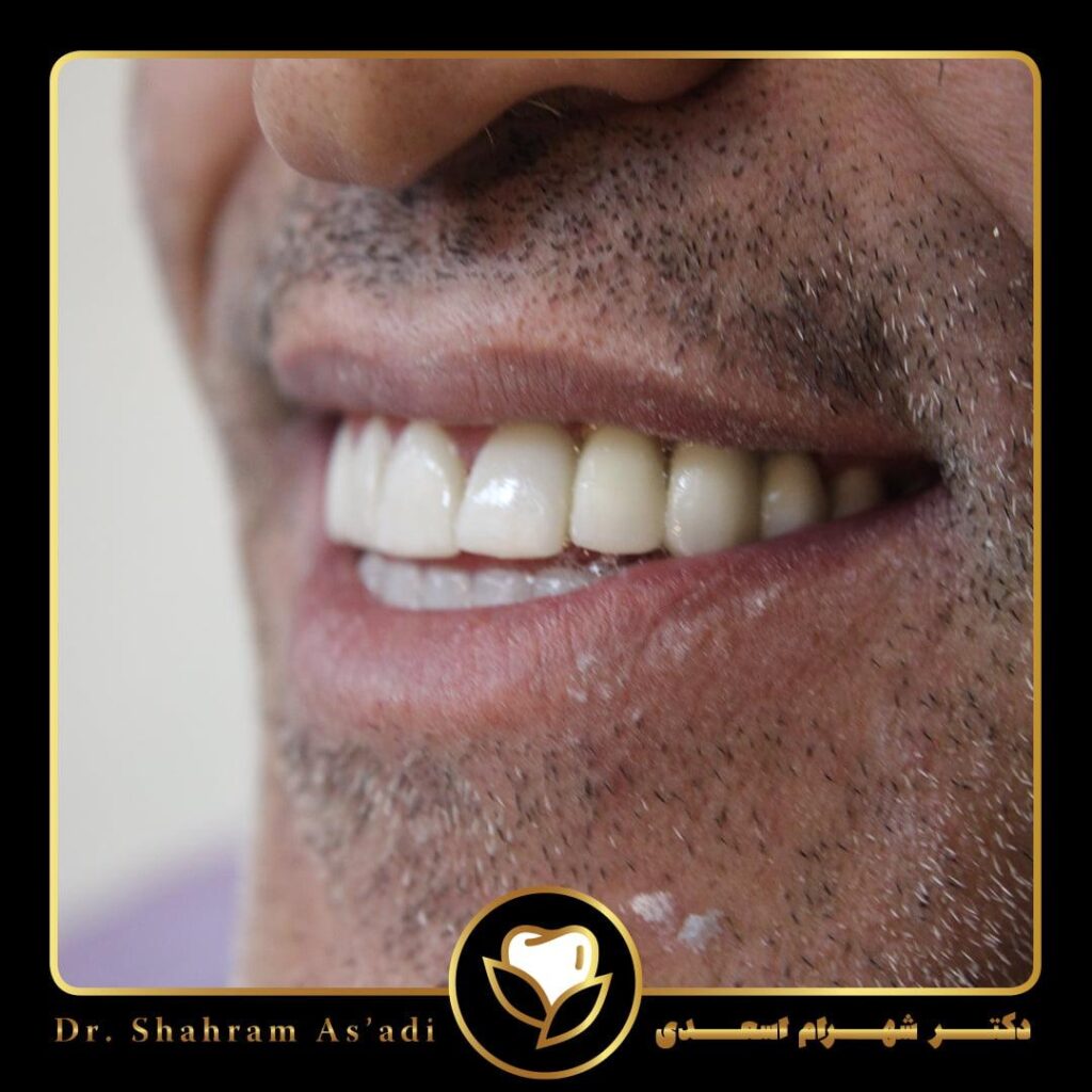 ایمپلنت به روش دیجیتال