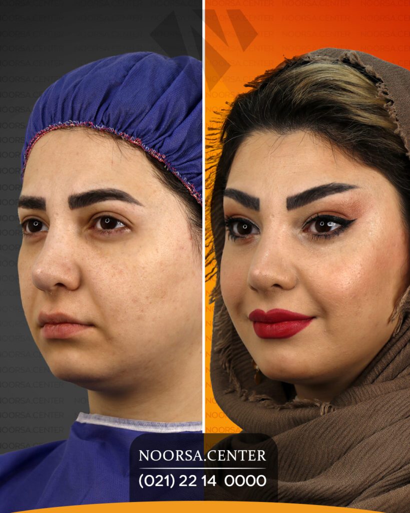 نتیجه لیفت شقیقه با جراحی