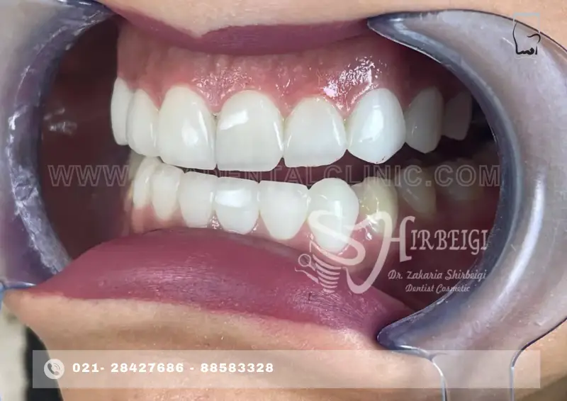 بلیچینگ دندان