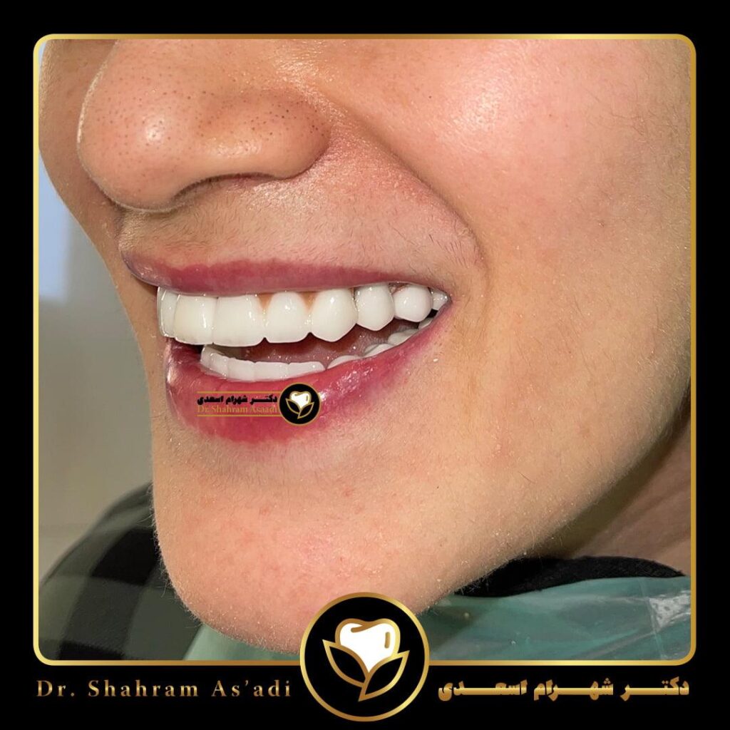 ایمپلنت به روش پانچ