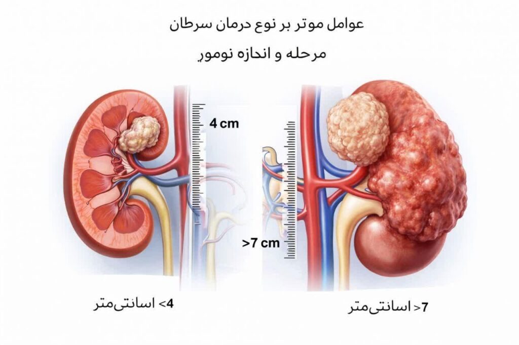 اثر اندازه تومور بر تشخیص نوع درمان