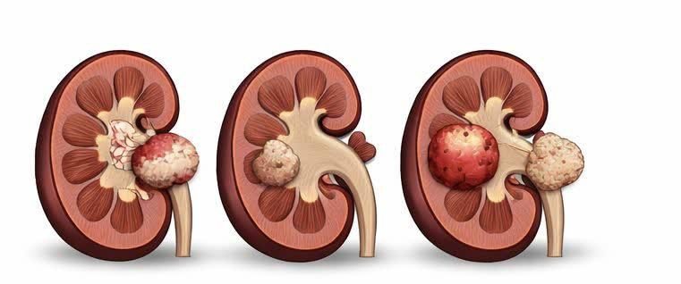 انواع سرطان کلیه