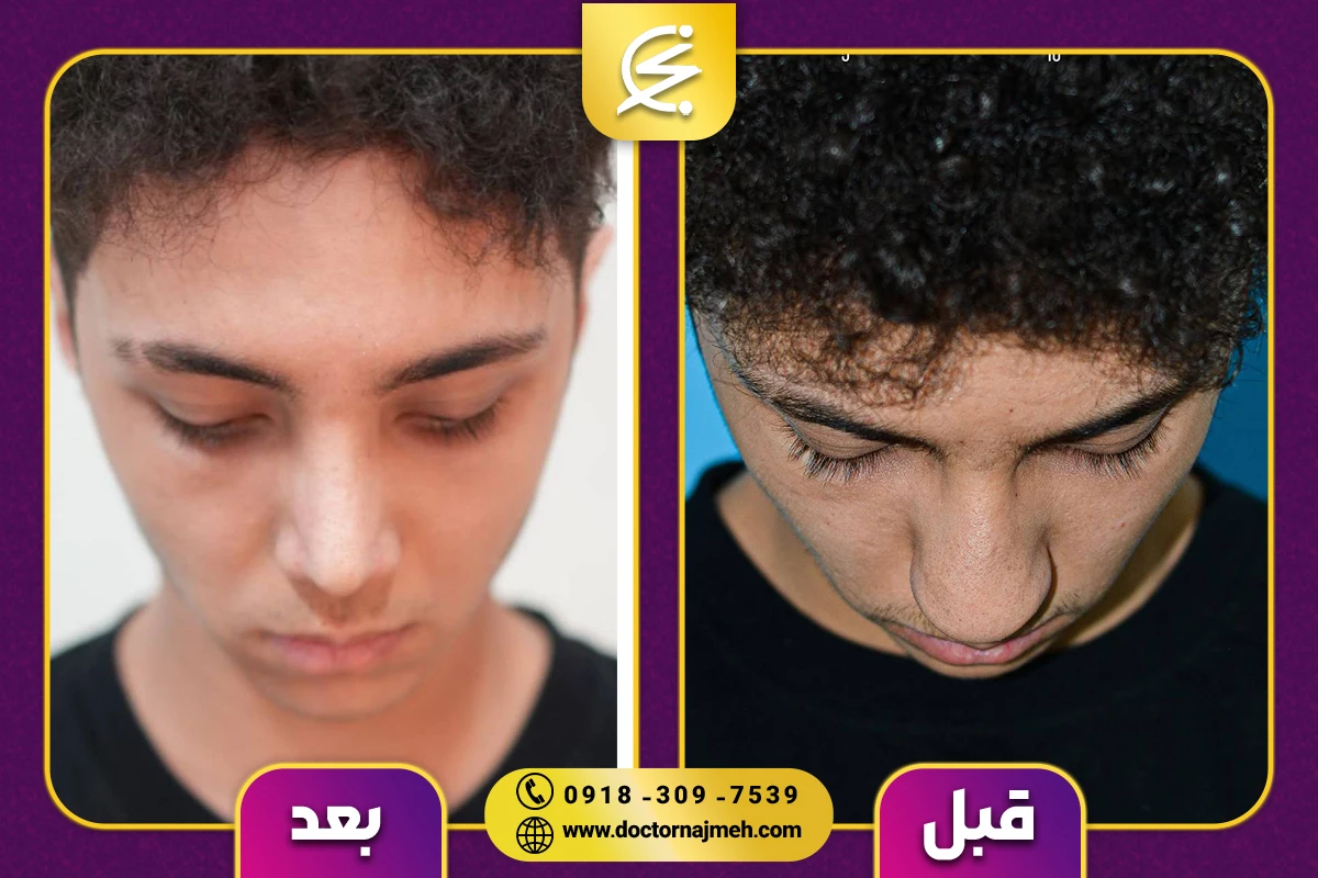 نمونه کار بهترین جراح بینی در کرمانشاه - دکتر نجمه برخورداری