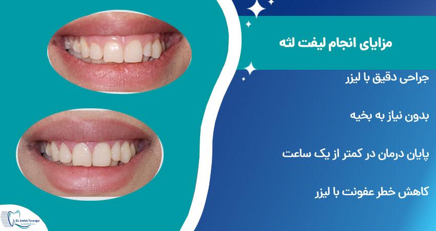 مزایا، مراقبتها و عوارض لیفت لثه