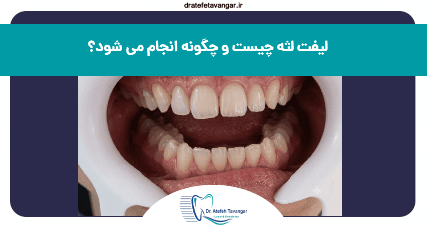 لیفت لثه چیست و چگونه انجام می شود؟