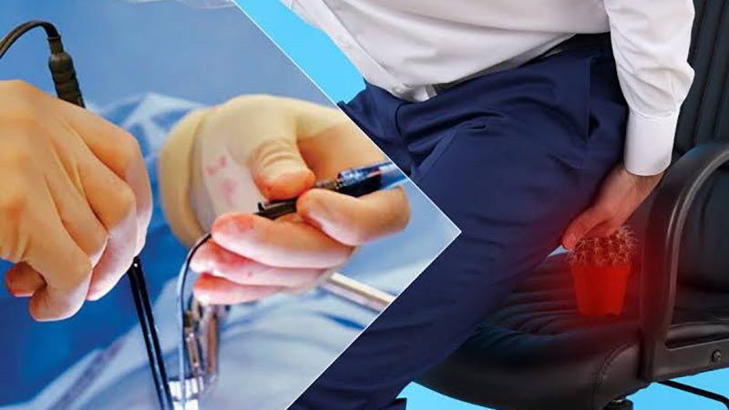 بهترین دکتر لیزر بواسیر