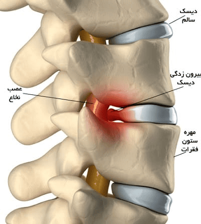آناتومی دیسک گردن و فشار بر ریشه عصبی