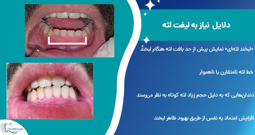 دلایل نیاز به لیفت لثه (زیبایی و درمانی)