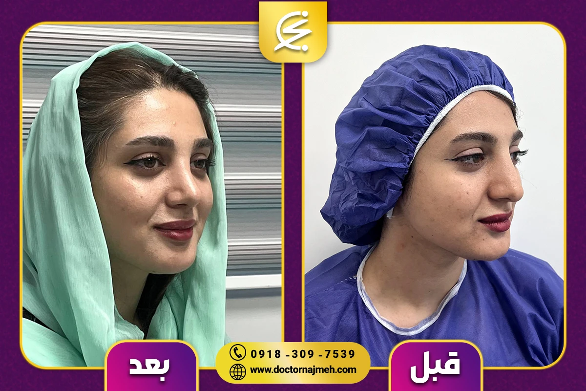 نمونه کار بهترین جراح بینی در کرمانشاه - دکتر نجمه برخورداری
