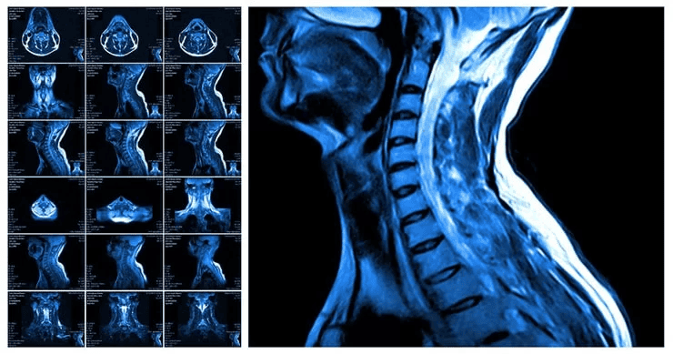 MRI گردن در بررسی دیسک و نخاع