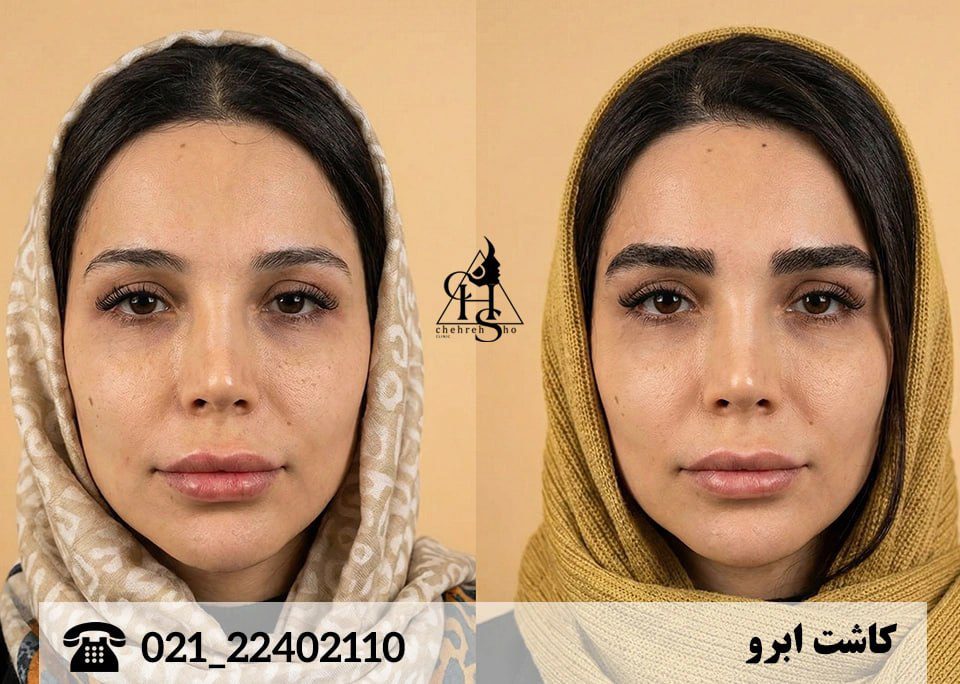 علت فر شدن ابروها بعد از کاشت چیست؟