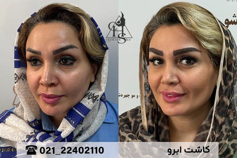 آیا میتوان از موی فر برای کاشت ابرو استفاده کرد؟