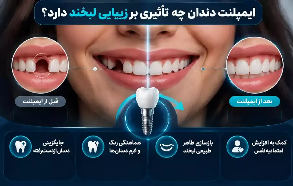 اصلاح طرح لبخند با ایمپلنت چه مزایایی دارد؟