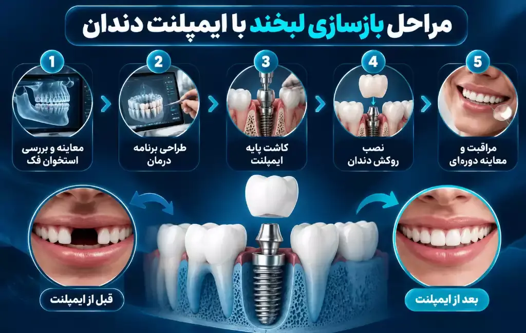 مراحل بازسازی لبخند با ایمپلنت دندان از معاینه فک تا نصب روکش و مراقبتهای بعد از کاشت
