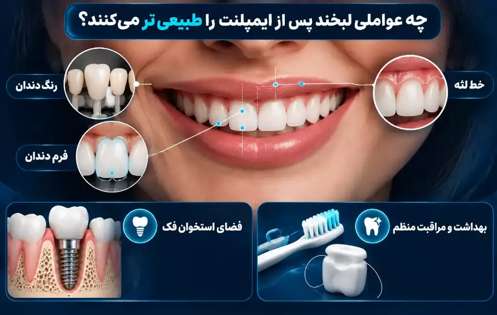 چه عواملی بر ماندگاری زیبایی لبخند پس از ایمپلنت تاثیر دارند؟