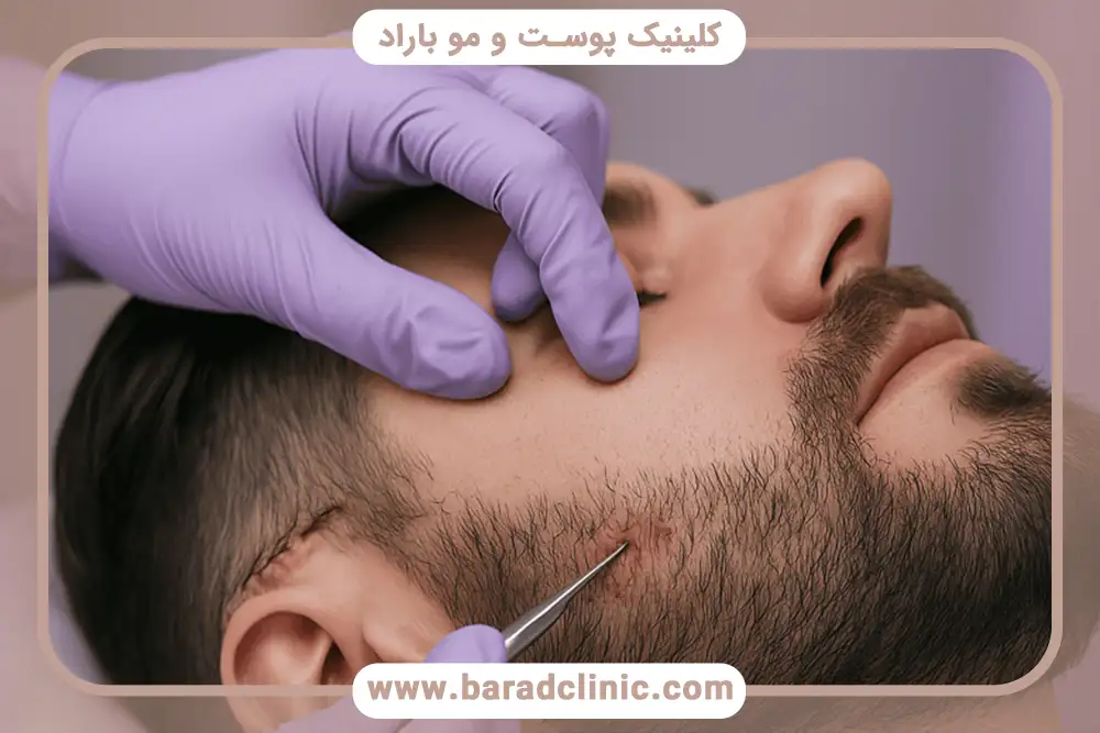 خدمات کاشت ریش و سبیل در کلینیک باراد تهران